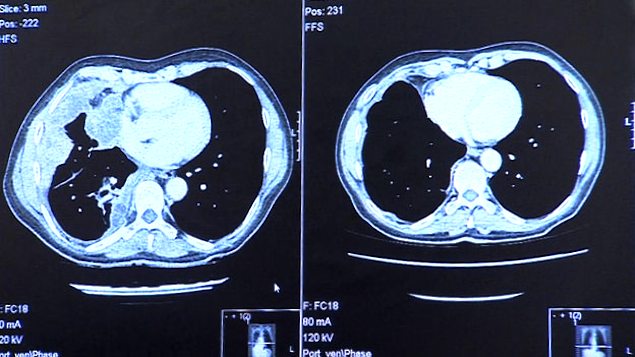 Exames de pulmão de Warwick Steele mostram o melanoma que atingiu o pulmão (esq.) e como os tumores encolheram depois do tratamento experimental
