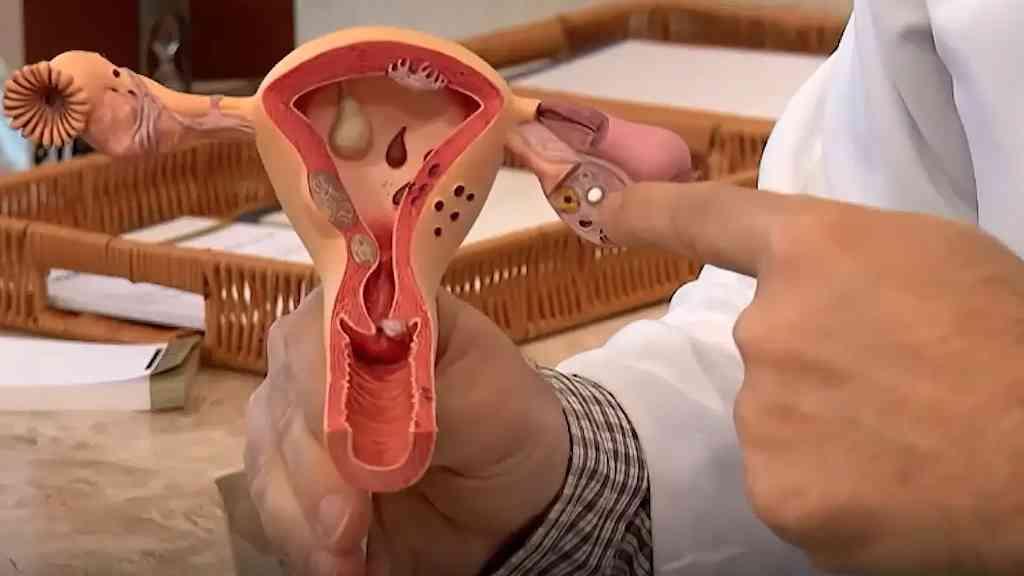 Endometriose: entenda os sintomas e as opções de tratamento | Exame ginecológico é o primeiro passo para a identificação da doença