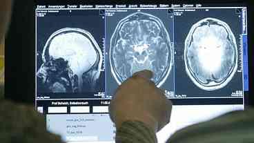 União Europeia aprova Lecanemab para Alzheimer