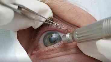 Cirurgia de Cor dos Olhos: Liberada Apenas para Cegos