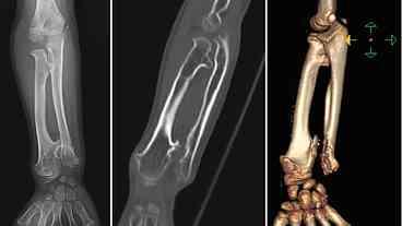 Radiologia e Diagnóstico de Tumores Ósseos Pediátricos