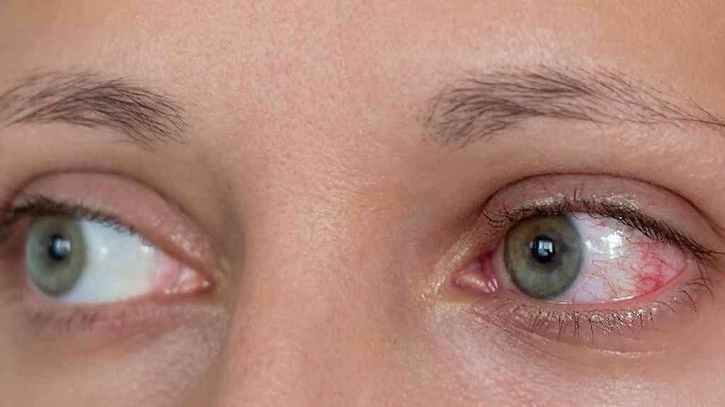 Uveíte responde por 35% dos casos de perda visual, alerta especialista | Reumatologista aponta ligação entre uveíte e perda de visão