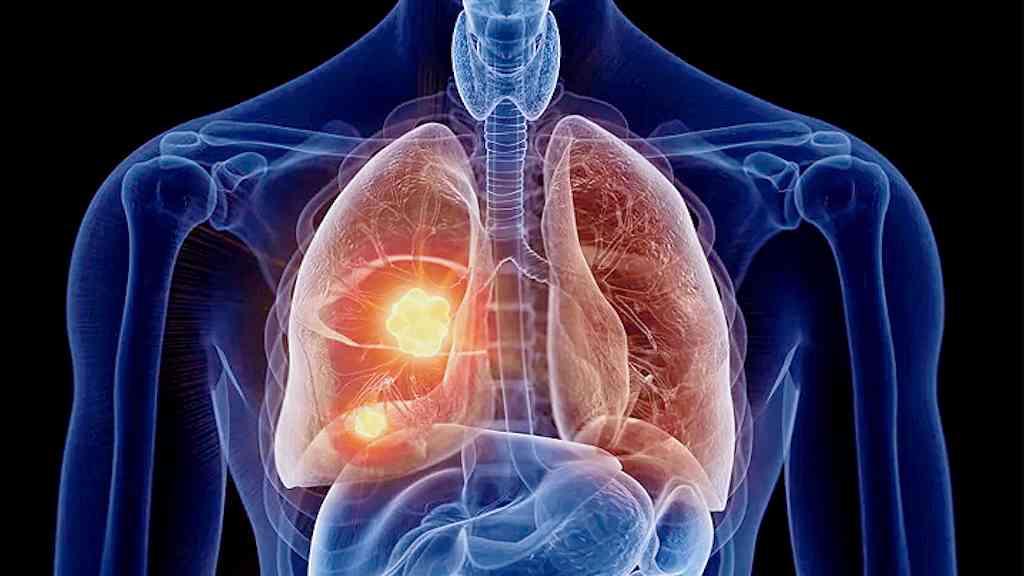 Câncer de pulmão segue como o mais letal, com baixa taxa de sobrevivência | Tumor de pulmão permanece líder em mortalidade, com só 30% vivos após 5 anos