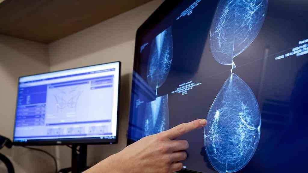 IA antecipa risco de câncer de mama por até cinco anos | Sistema de inteligência artificial Clairity Breast foi treinado com centenas de milhares de mamografias