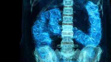 Câncer Colorretal em Jovens: Aumento Alarmante