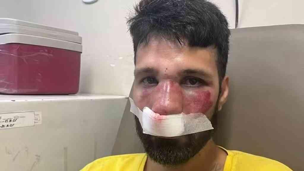 DJ é confundido com ladrão e agredido por entregadores | Bruno teve o nariz quebrado, além de escoriações pelo corpo