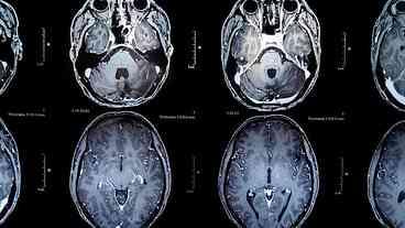 Vacina surge como esperança contra tumores cerebrais